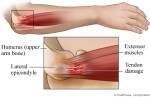 tennis elbow